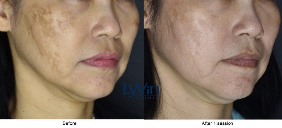 Realistic Results at Lyvin Clinic JB | Multifrax Before & After